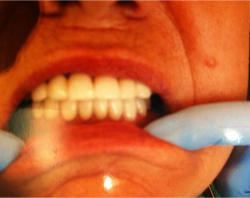 The image shows a person with their mouth open, displaying teeth, while wearing blue gloves, possibly indicating dental care or hygiene.