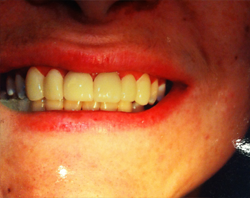 The image shows a close-up of a person s smiling mouth with teeth, featuring a red lipstick application on the lips.