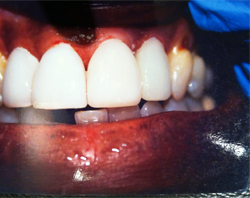 The image shows a close-up view of an individual s lower face with teeth, including a front tooth that appears damaged or discolored, set against a background that includes a partial view of a medical setting, possibly dental, indicated by the presence of a blue surgical gown and what seems to be a surgical instrument.