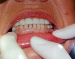 The image shows a person with their mouth open, displaying teeth being worked on by dental professionals using tools, likely in a dental office setting.