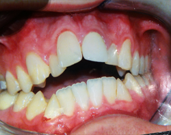 The image shows a close-up of an open mouth with teeth and gums, revealing a dental condition such as infection or decay.