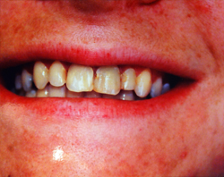 The image shows a close-up of a person with a toothy smile, revealing yellowed teeth and gums.