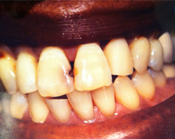 The image displays a close-up view of a person s mouth with teeth showing signs of decay and discoloration, accompanied by an open smile revealing the inner surfaces of the teeth.