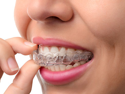 A person with clear braces on their teeth, holding a small object near their mouth.