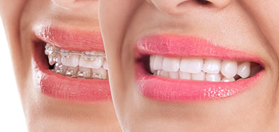 The image shows a close-up view of a woman s smiling face with pink lipstick, set against a white background, accompanied by a smaller inset showing her teeth.