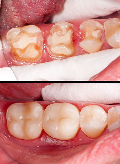 The image shows two photographs side by side  on the left is an extreme close-up of a person s mouth with severe tooth decay, and on the right is a subsequent view after dental treatment, revealing restored teeth.