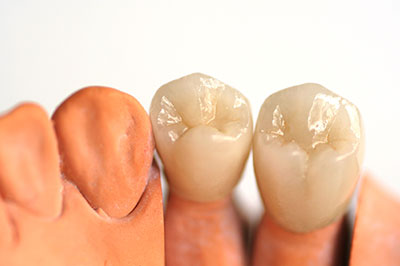 The image displays two artificial teeth with visible crowns placed next to each other against a white background.