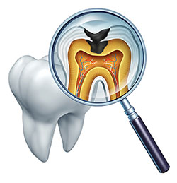 An illustration showing a magnified view of an open tooth cavity with a focus on the inner structure and a small fish-like creature inside, viewed through a magnifying glass.