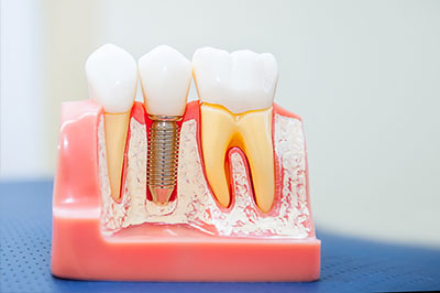 The image shows a display of dental implants with visible screws and teeth-like structures, set against a pink background.