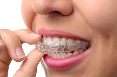 A woman wearing braces with her mouth open while holding a toothpaste tube.