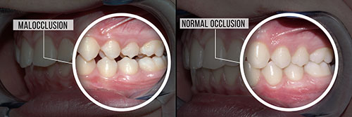 The image shows two photographs side by side of a person s teeth with an overlay text labeling them  malocclusion  and  normal occlusion.