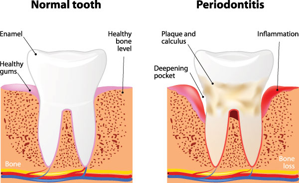 The image displays a diagrammatic representation of the human mouth showing normal tooth structure and two stages of periodontitis with accompanying labels indicating bone loss and inflammation.