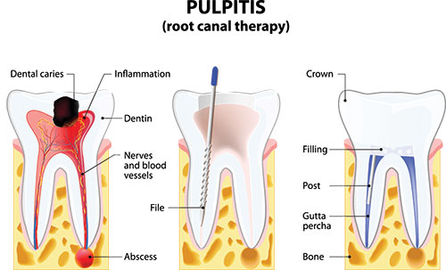 The image shows a diagrammatic representation of a dental pulpitis illustration with labels for different parts of the tooth, including the crown, root canal, dentin, nerves, filing, and a toothbrush, set against a background that resembles a cross-section of a tooth with its layers.