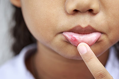 A young child with acne on their face, pointing to a pimple with their finger.