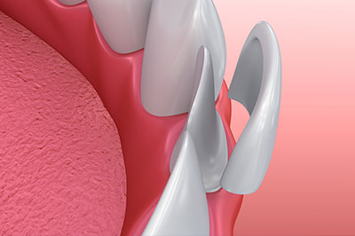 The image shows a close-up view of an artificial tooth with a visible screw, set against a red background.