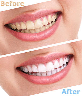 The image displays a before-and-after comparison of dental whitening treatments, featuring two photographs of a person s smile with noticeable teeth whitening results.