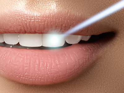 The image features a close-up of a person s lips with a focus on their teeth and lipstick, showcasing a product or service related to cosmetic dental care or beauty enhancement.